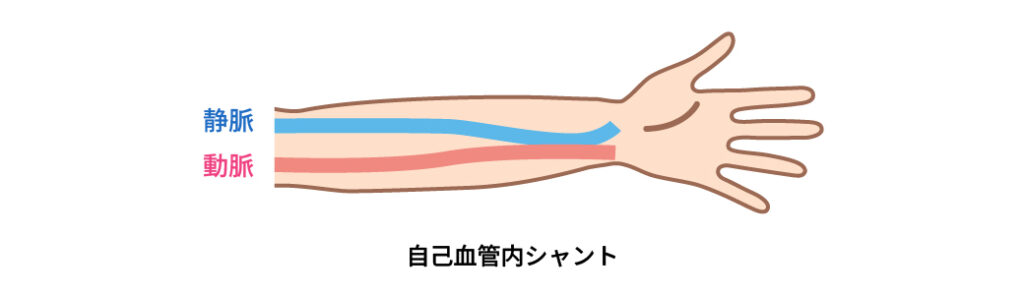 自己血管内シャントを示す図