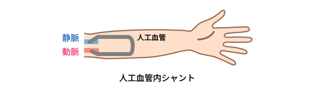 人工血管内シャントを示す図
