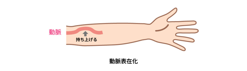 動脈表在化を示す図
