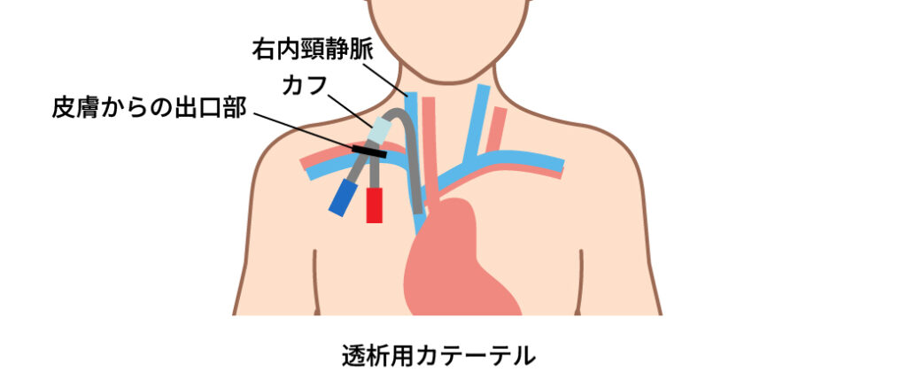 透析用カテーテルを示す図