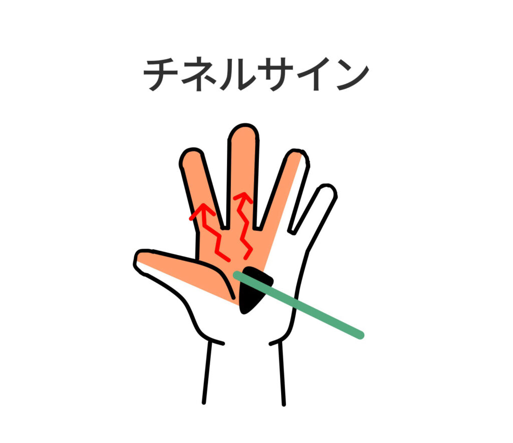 チネルサイン